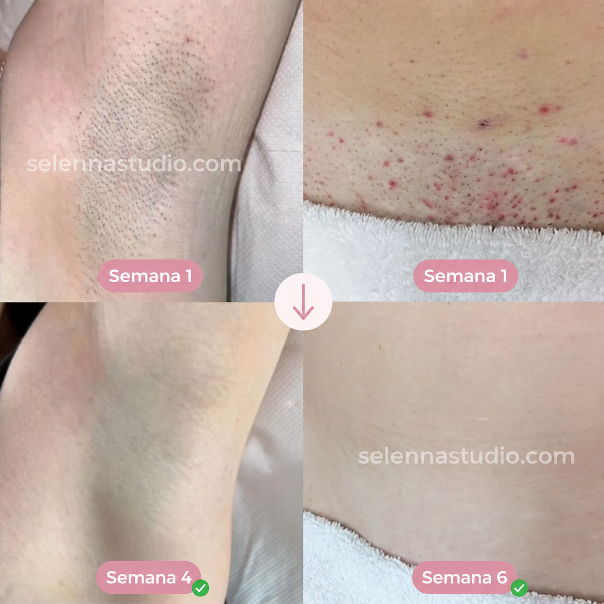 SELENNA IPL PRO™